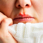 Cold sores
