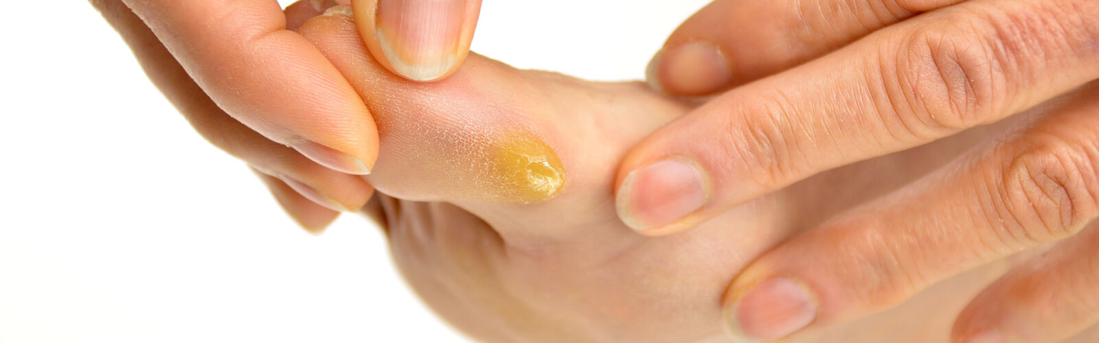 How to treat and remove a callus