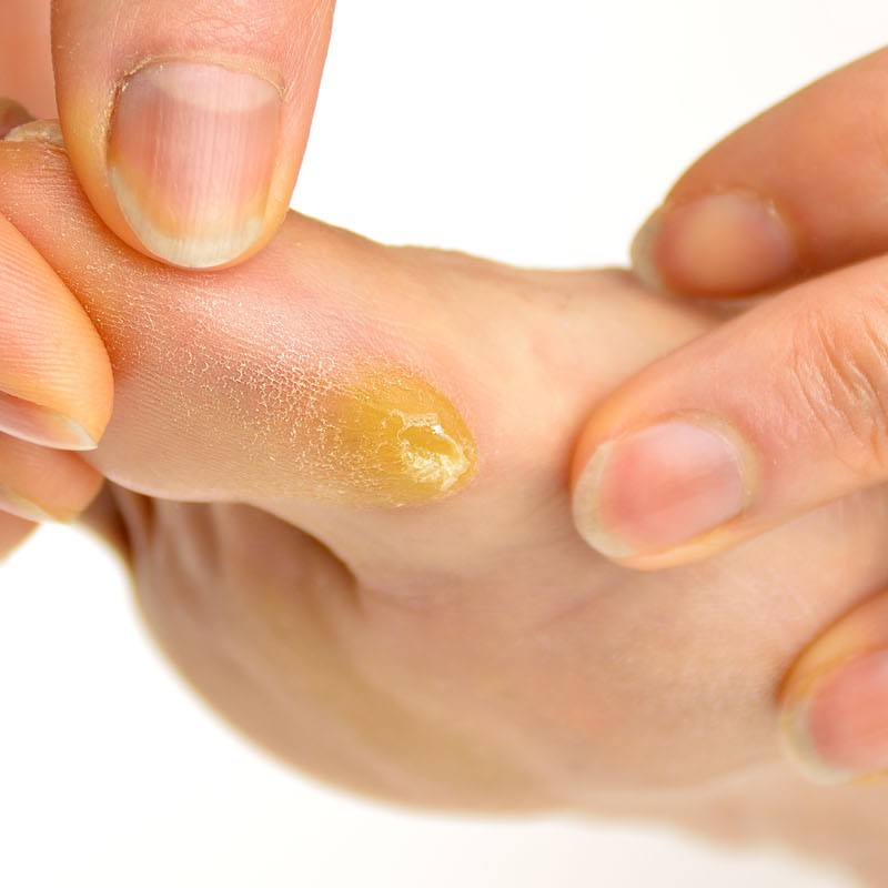 How to treat and remove a callus COMPEED®