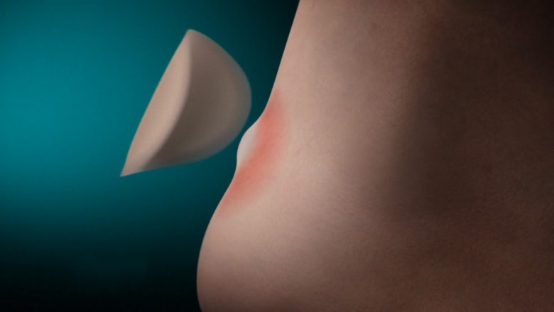 Hydrocolloid technology